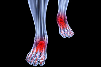 Arthritic foot and ankle care treatment, foot arthritis treatment in the Marlton, NJ 08053 area