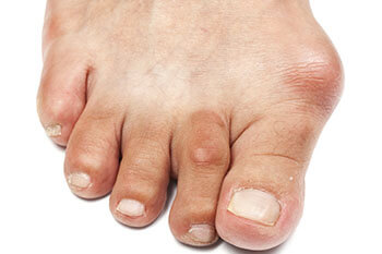 Bunions - NHS