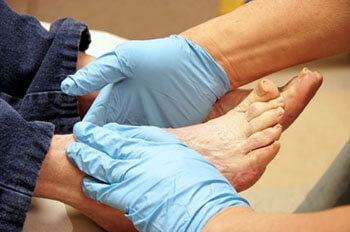 Diabetic foot treatment and care, Diabetic Ulcers Treatment & Management in the Marlton, NJ 08053 area