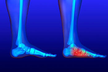 Flat feet and Fallen Arches treatment, Flatfoot Deformity Treatment in the Marlton, NJ 08053 area