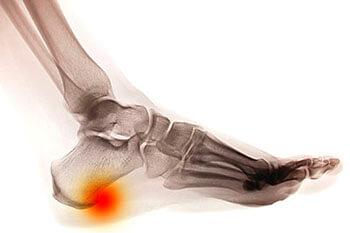 Heel spurs treatment in the Marlton, NJ 08053 area