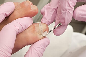 Ingrown toenails treatment in the Marlton, NJ 08053 area
