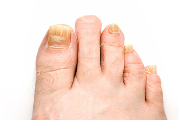 Toenail Fungus, Fungal toenails diagnosis and treatment in the Marlton, NJ 08053 area