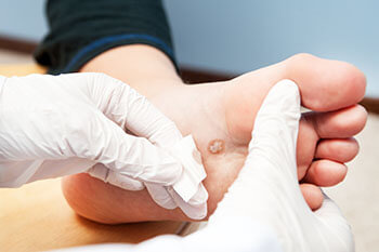 Plantar warts treatment in the Marlton, NJ 08053 area