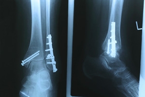 Sports That Cause Most Ankle Injuries