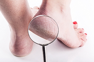 Cracked Heels in Men and Women