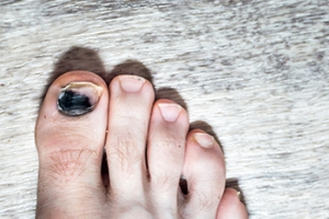 Causes and Symptoms of Bruised Toenails