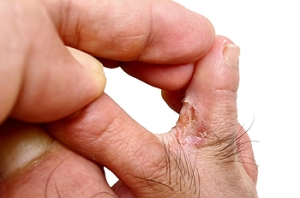 What Does Athlete’s Foot Look Like?