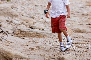 Clubfoot and the Ponseti Method for Treatment