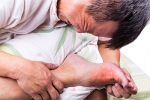Gout Often Begins in the Big Toe