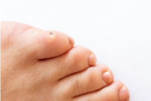 Common Causes of Foot Corns