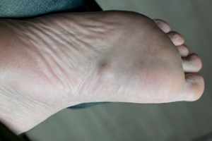 Risk Factors of Plantar Fibromas